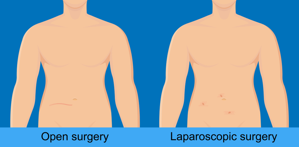 Illustration comparing open surgery with a single large abdominal scar to laparoscopic surgery with several tiny incision marks, used to explain minimally invasive urologist treatment in Indore by Dr. Pritesh Shrimali, best urologist in Indore.
