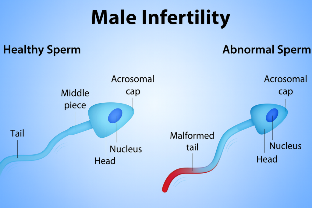 Male infertility illustration comparing healthy sperm with normal head, nucleus, acrosomal cap and tail to abnormal sperm with a malformed tail, used for male infertility treatment information in Indore by Dr. Pritesh Shrimali, best urologist in Indore.