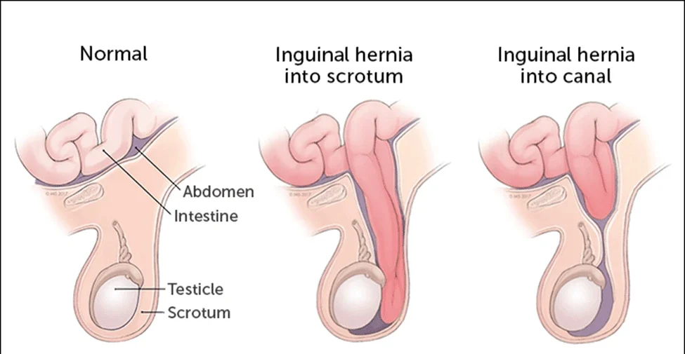 Medical illustration showing a normal male groin, an inguinal hernia into the scrotum and an inguinal hernia into the canal, used to explain hernia conditions treated by Dr. Pritesh Shrimali, best urologist in Indore.