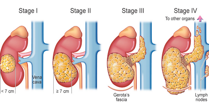 Medical illustration showing stages I to IV of kidney cancer in the kidney and surrounding structures, explaining how the tumour grows and spreads to nearby tissues and lymph nodes, used for kidney cancer treatment information in Indore by Dr. Pritesh Shrimali, best urologist in Indore.