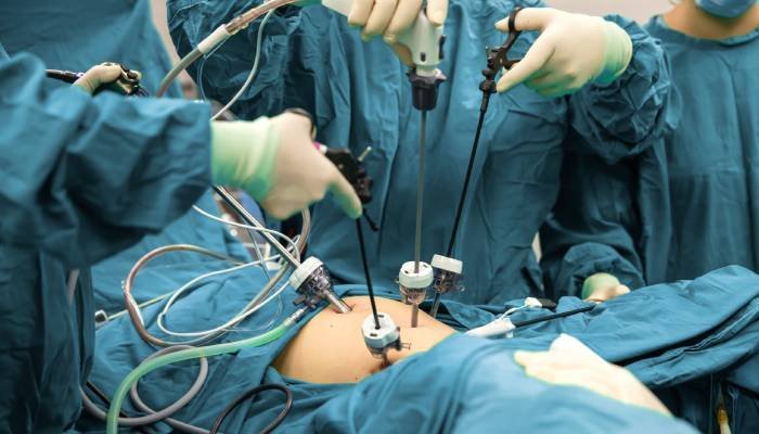 Surgeons performing laparoscopic surgery with multiple trocars and long instruments inserted through small keyhole incisions in the abdomen, demonstrating advanced minimally invasive urologist treatment in Indore by Dr. Pritesh Shrimali, best urologist in Indore.