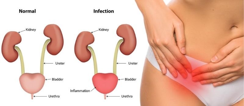 Comparison of a normal urinary tract and an infected, inflamed bladder next to a woman holding her lower abdomen in pain, illustrating urinary tract infection symptoms treated in Indore by Dr. Pritesh Shrimali, best urologist in Indore.