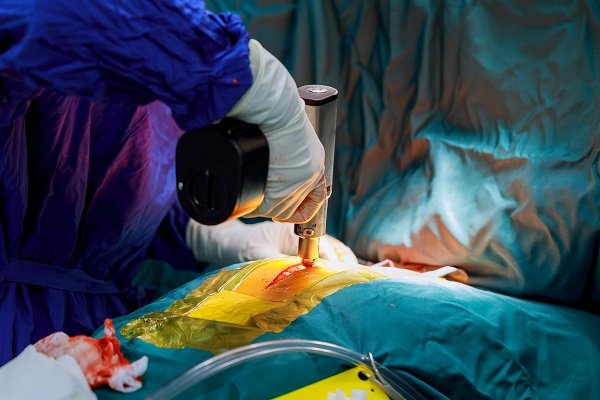 Surgeon using a specialised surgical tool over a small abdominal incision in a fully draped patient, demonstrating advanced minimally invasive urology or kidney surgery performed in Indore by Dr. Pritesh Shrimali, best urologist in Indore.