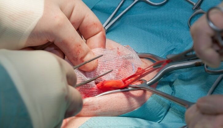 Close‑up of a urology surgery being performed with surgical instruments and gauze, representing advanced urologist treatment in Indore by Dr. Pritesh Shrimali.