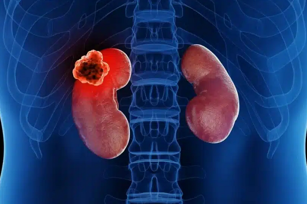 3D illustration of both kidneys inside the torso, with the left kidney highlighted in red and showing a protruding tumour mass to depict kidney cancer or renal cell carcinoma, used for kidney cancer awareness and urologist treatment information in Indore by Dr. Pritesh Shrimali, best urologist in Indore.