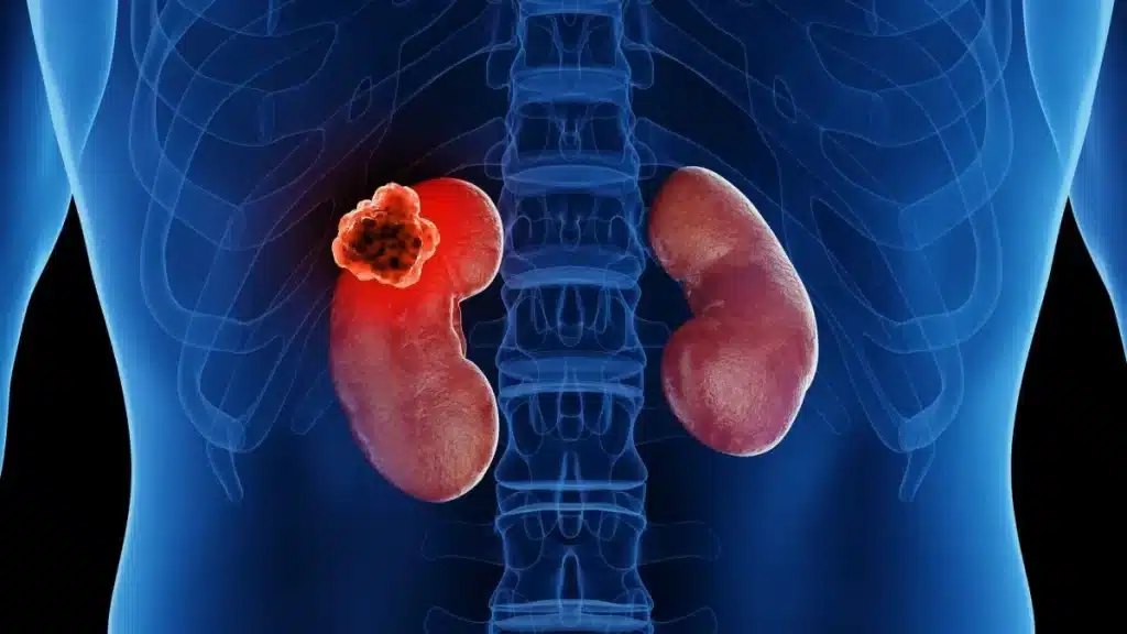 3D illustration of both kidneys inside the torso, with a bright red tumour on the left kidney representing kidney cancer or renal cell carcinoma, used for kidney cancer awareness and urologist treatment information in Indore by Dr. Pritesh Shrimali, best urologist in Indore.