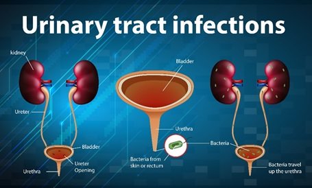 Medical illustration of urinary tract infections showing kidneys, ureters, bladder and urethra with bacteria entering the urinary tract, used to explain UTI treatment in Indore by Dr. Pritesh Shrimali, best urologist in Indore.
