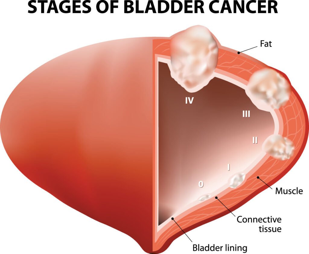 Medical illustration of the stages of bladder cancer showing a cross‑section of the bladder wall with tumors progressing from stage 0 on the bladder lining through stages I, II and III into the muscle, connective tissue and surrounding fat, used to explain staging and urologist treatment in Indore by Dr. Pritesh Shrimali, best urologist in Indore.